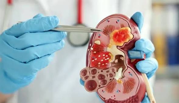 Kidney Stones: Symptoms, Causes and How to Prevent Them